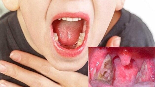 Mẹo chữa viêm họng cho bé không dùng kháng sinh mà bố mẹ nên biết 1