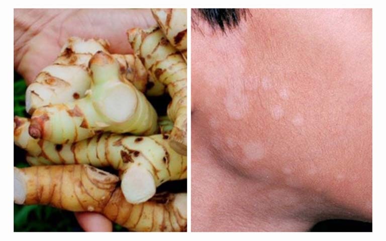 Mẹo trị lang ben bằng củ riềng có hiệu quả không?