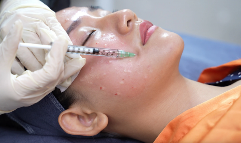 Meso khác filler phải không? Giải đáp từ chuyên gia 1