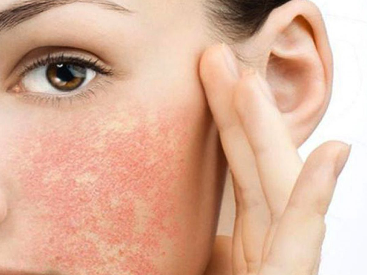 Stearoxytrimethylsilane làm dịu hiệu quả vùng da đang kích ứng, tổn thương