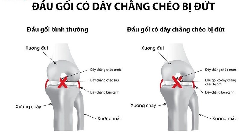 Mổ dây chằng chéo trước bao lâu thì bỏ nẹp? Chế độ tập luyện cho người bệnh đúng nhất 1
