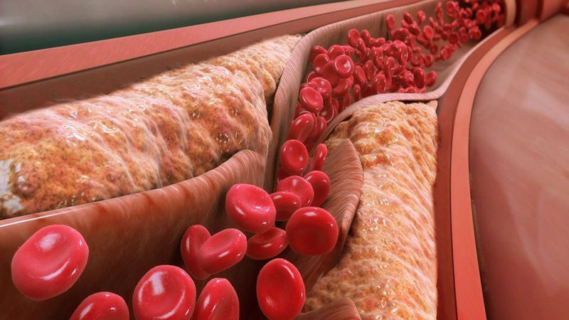 Mỡ máu thấp: Nguyên nhân, triệu chứng và cách điều trị 1