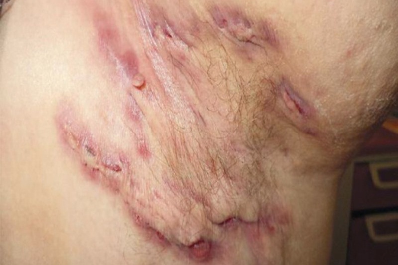 Mọi điều cần biết về cắt tuyến mồ hôi nách 2