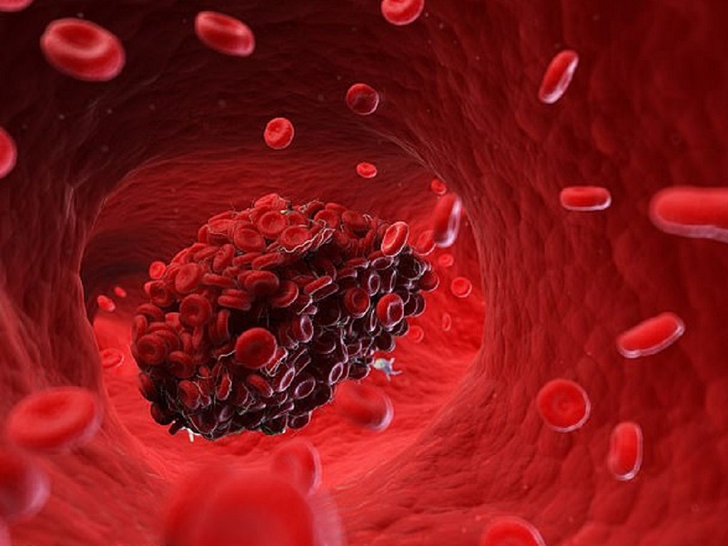 Mọi điều cần biết về hội chứng suy nút xoang tim 2