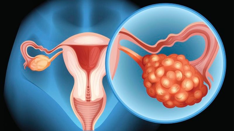 Khung chậu nữ giới và những bệnh lý liên quan2