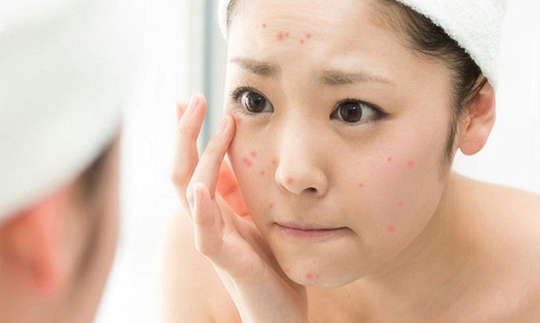 Một số cách trị mụn bọc ở mũi hiệu quả nhanh chóng 2