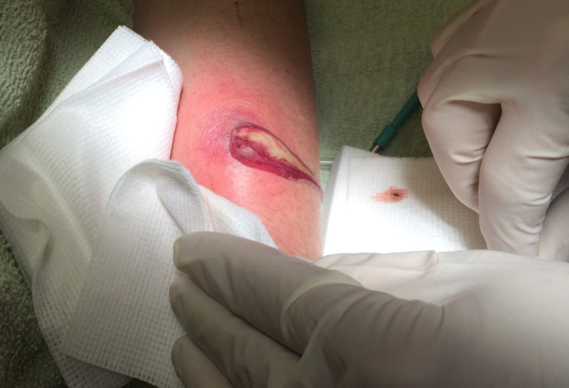 Mụn áp xe là gì? Nguyên nhân và cách điều trị hiệu quả 5