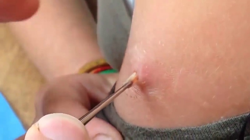 Mụn áp xe là gì? Nguyên nhân và cách điều trị hiệu quả 4