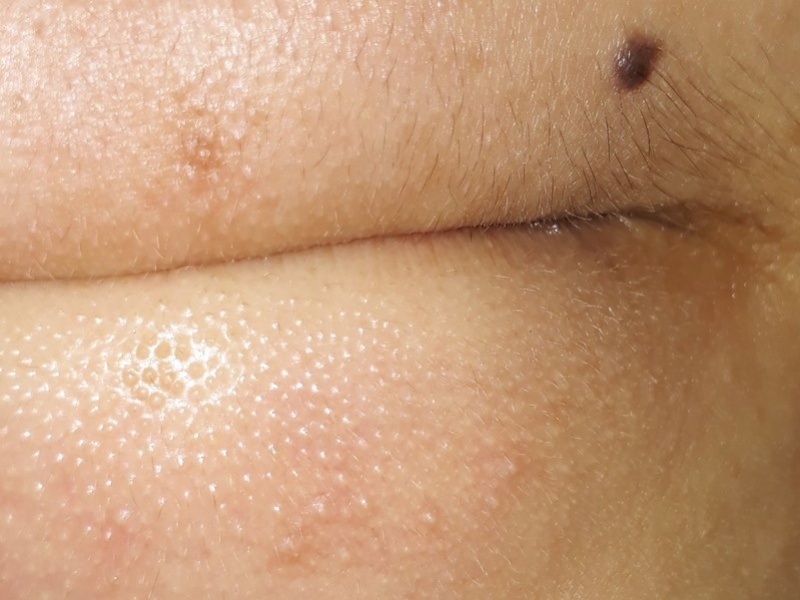 Mụn cám ở cằm: Nguyên nhân, dấu hiệu và cách điều trị 1