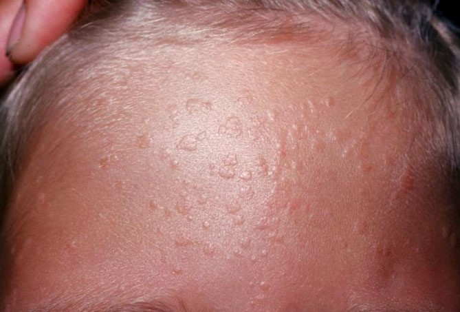 Mụn cóc phẳng: Dấu hiệu nhận biết, nguyên nhân và cách phòng ngừa 4