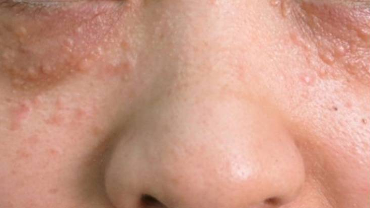 mun-com-o-mat-nguyen-nhan-dau-hieu-va-cach-dieu-tri 1.jpg