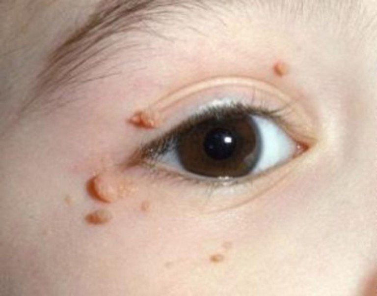 mun-com-o-mat-nguyen-nhan-dau-hieu-va-cach-dieu-tri 3.jpg