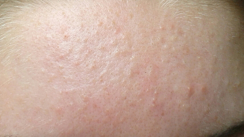 Mụn li ti: Nguyên nhân và cách điều trị 1