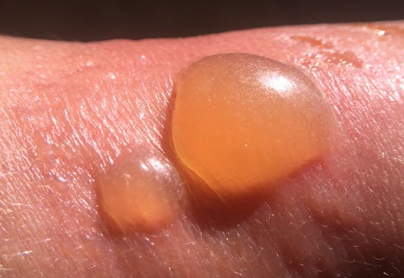 Mụn nước là gì? Cách điều trị hiệu quả 2