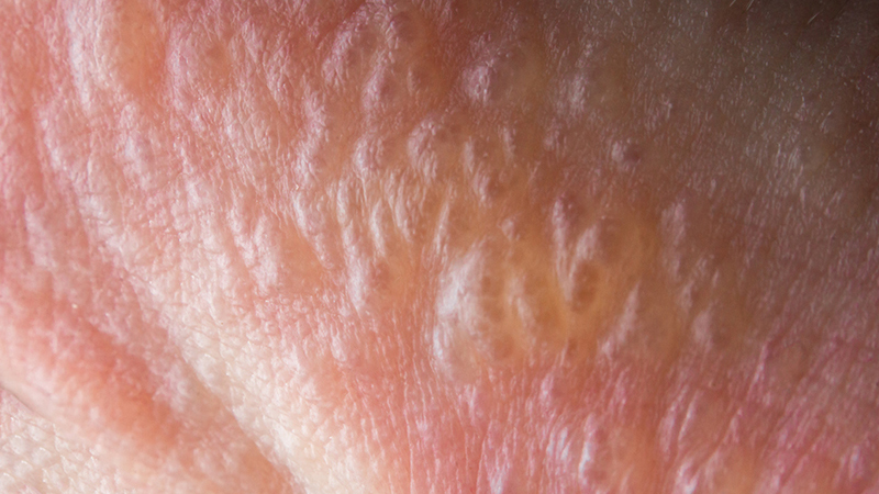 Mụn nước là gì? Cách điều trị hiệu quả 1