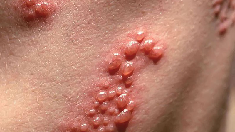 Mụn rộp sinh dục giai đoạn đầu có điều trị được không? Dấu hiệu nhận biết và phương pháp điều trị hiệu quả 2