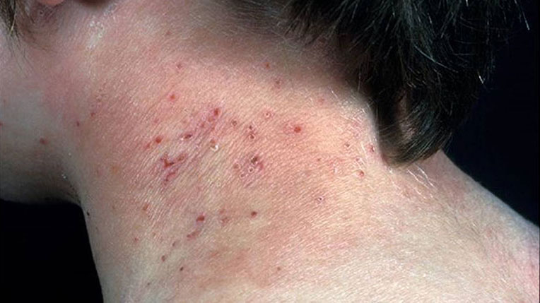 Mụn sau gáy: Nguyên nhân và cách khắc phục an toàn, hiệu quả 1