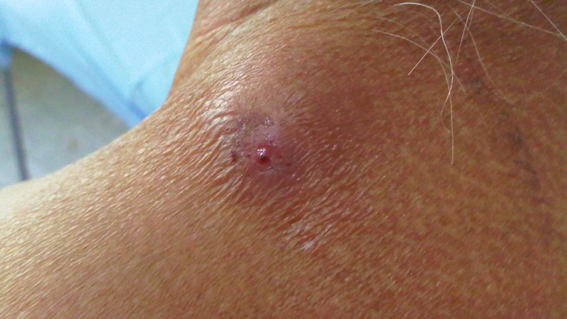 Myiasis da: Nguyên nhân, triệu chứng và cách điều trị