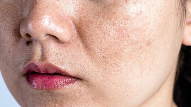 nam-da-sau-sinh-co-tu-het-khong-cach-cai-thien-tinh-trang-nam-da-sau-sinh 1