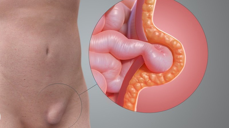 Thoát vị bẹn là gì? Vì sao nam giới bị thoát vị bẹn nhiều hơn nữ giới? 1
