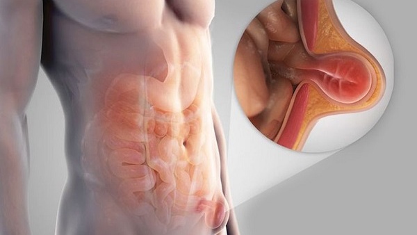 Thoát vị bẹn là gì? Vì sao nam giới bị thoát vị bẹn nhiều hơn nữ giới? 3