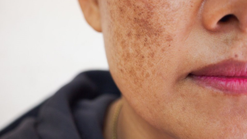 Nám hỗn hợp là gì? Có chữa được không? 1