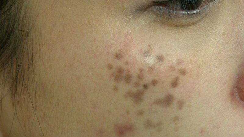 Nám hori là gì? Chữa dứt điểm được không? 1