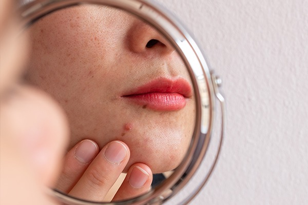 Có nên nặn mụn hay không? 2