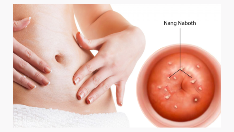 Nang naboth cổ tử cung 11mm có nguy hiểm không? 1