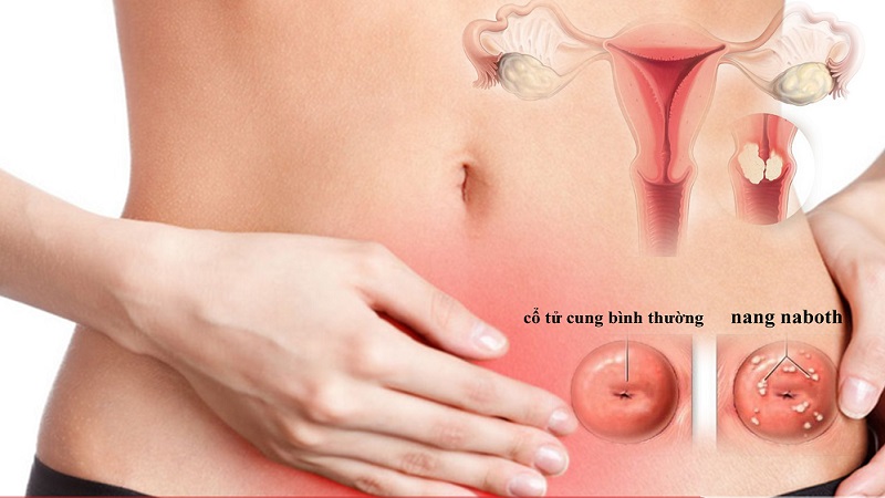 Nang naboth cổ tử cung 11mm có nguy hiểm không? 5