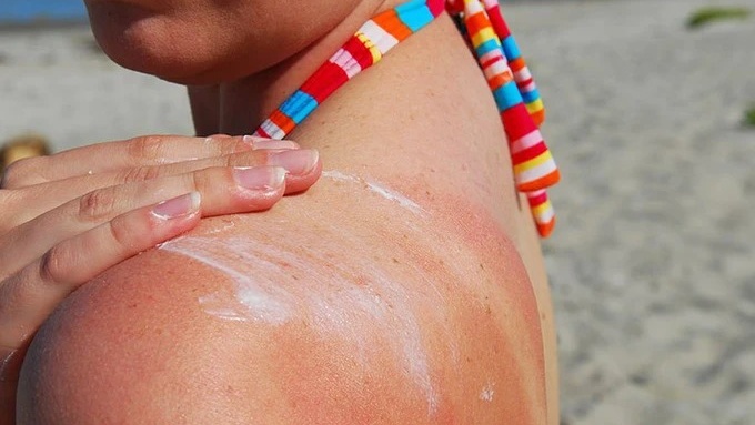 Nên làm gì khi ngộ độc ánh nắng mặt trời? 1