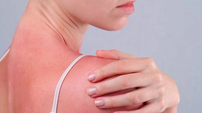 Nên làm gì khi ngộ độc ánh nắng mặt trời? 3