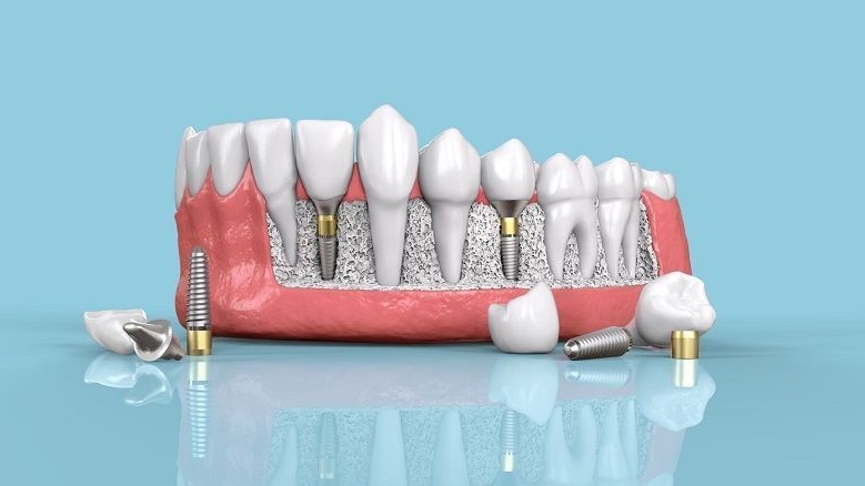 Nên làm răng giả tháo lắp hay cố định? 2