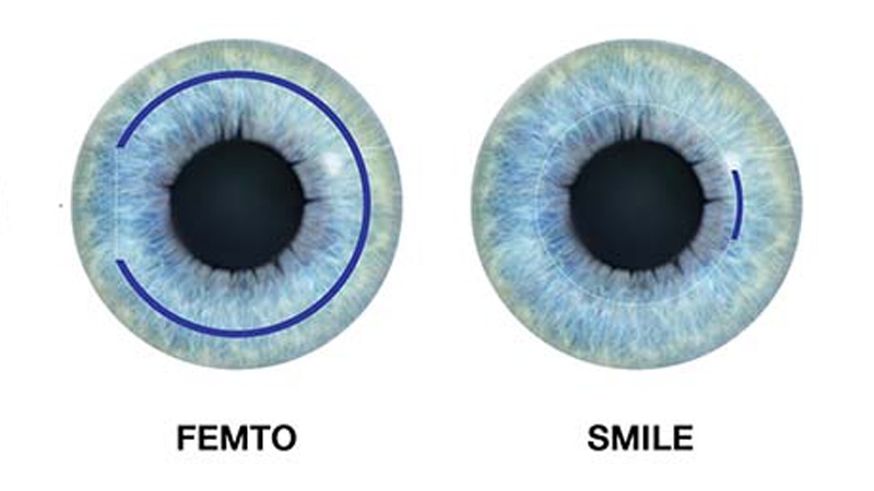 So sánh mổ cận Femto Lasik và Relex Smile: Nên chọn phương pháp nào? 1
