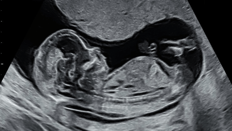 Nếp gấp da gáy là gì? Tại sao đo nếp gấp da gáy lại quan trọng? 1