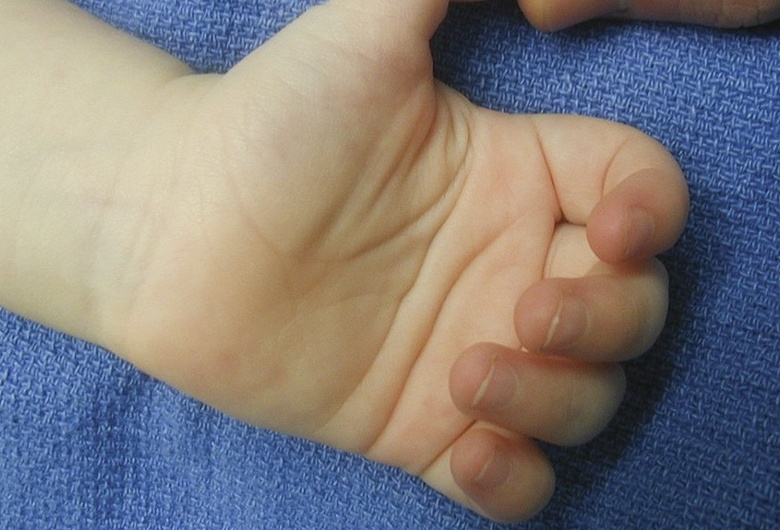 Ngón tay bị cong bẩm sinh: Nguyên nhân, triệu chứng và cách điều trị hiệu quả 2