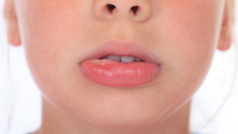 Ngủ dậy bị sưng môi dưới nguyên nhân do đâu? 2
