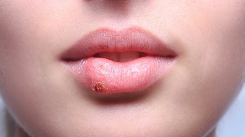 Ngủ dậy bị sưng môi dưới nguyên nhân do đâu? 3