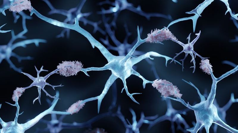 Nguồn gốc bệnh Alzheimer là gì và cách phòng ngừa 2