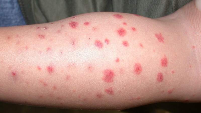 Nguyên nhân gây ban xuất huyết và cách phòng ngừa 1