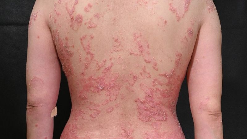 Nguyên nhân bệnh vảy nến và biện pháp phòng ngừa 1