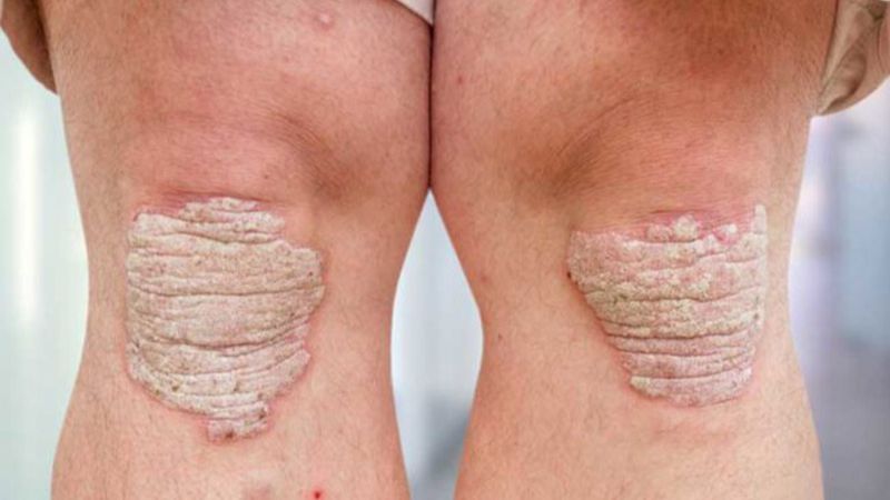 Nguyên nhân bệnh vảy nến và biện pháp phòng ngừa 4