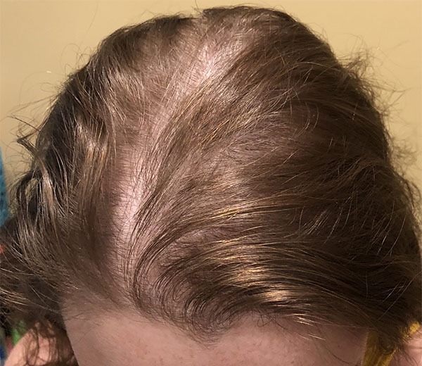 nguyen-nhan-dan-den-tinh-trang-rung-toc-telogen 2.jpg