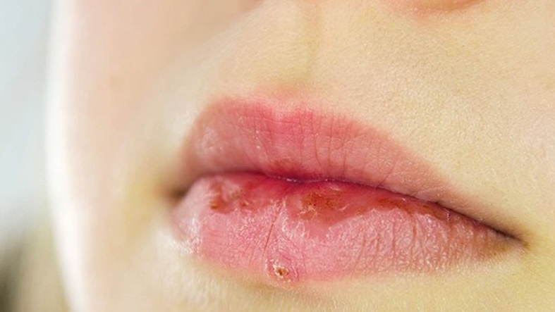 Nguyên nhân gây khô môi là gì? 1