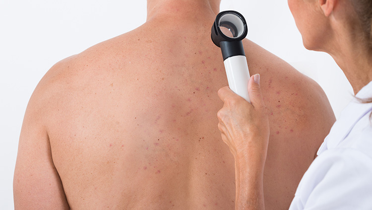 Nguyên nhân gây mụn lưng nam giới và cách điều trị 4