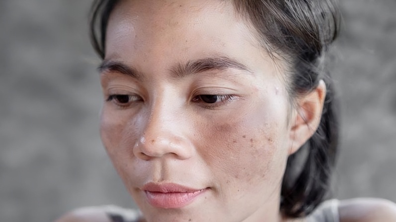 Những nguyên nhân gây nám tàn nhang có thể bạn chưa biết 3