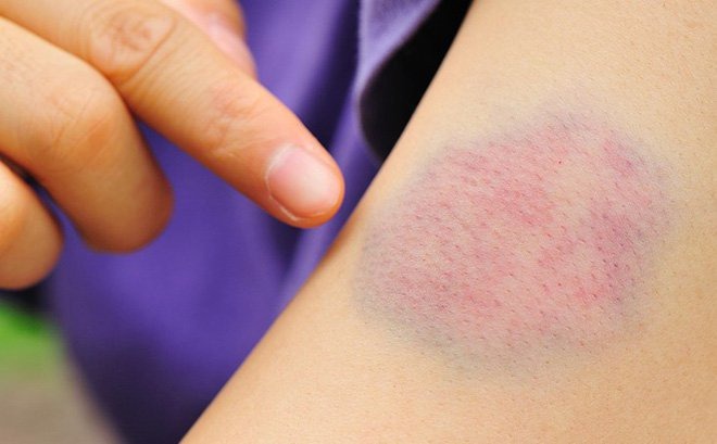 Nguyên nhân gây nên tình trạng xuất huyết mạch máu 1