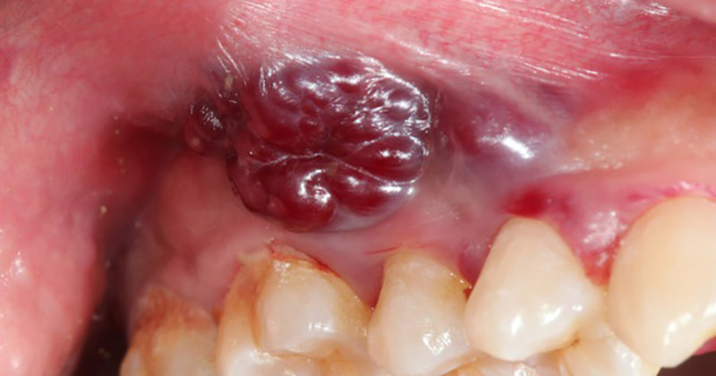 Nguyên nhân gây nhiệt miệng màu đen và cách điều trị hiệu quả 4