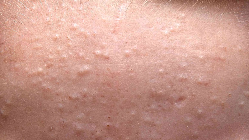 Nguyên nhân gây ra mụn ẩn là gì? 1