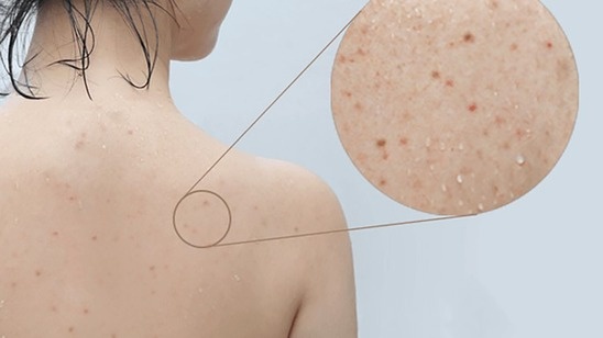 nguyen-nhan-hinh-thanh-mun-the-thao-va-cach-phong-ngua-hieu-qua Cropped.jpg